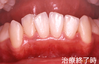 歯肉炎の症例：治療終了時