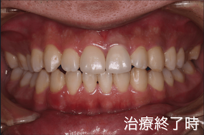 軽度歯周病の症例：治療終了時