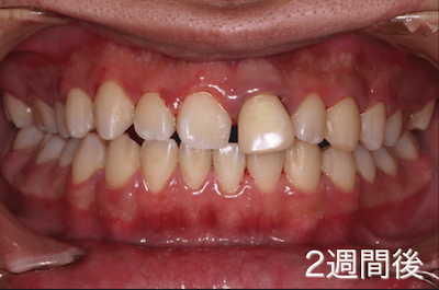 軽度歯周病の症例：２週間後