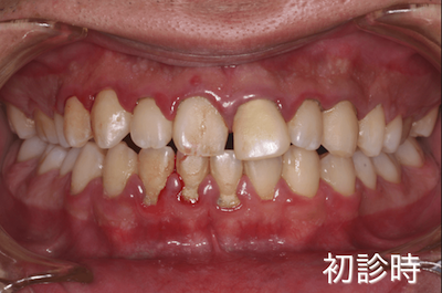 軽度歯周病の症例：初診時