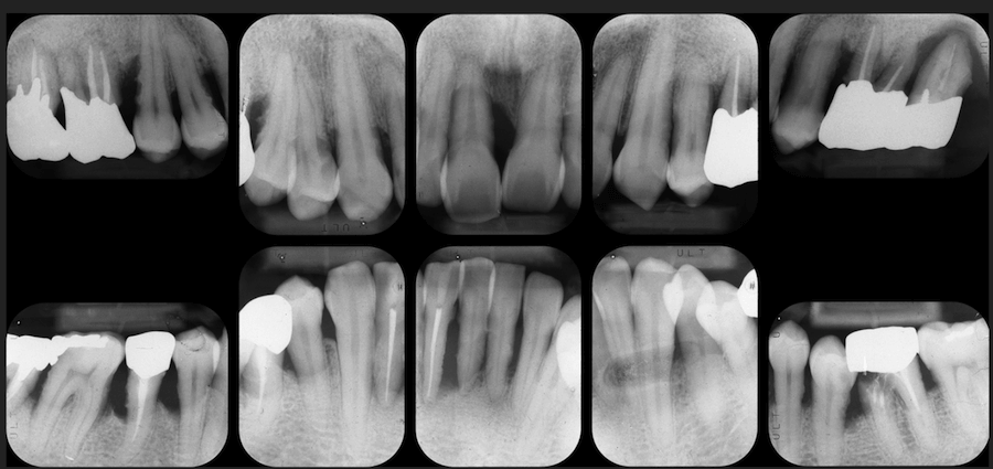 中等度歯周病 中等度歯周炎初診時レントゲン