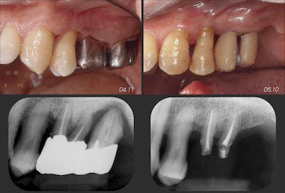 中等度歯周病 中等度歯周炎歯周基本治療
