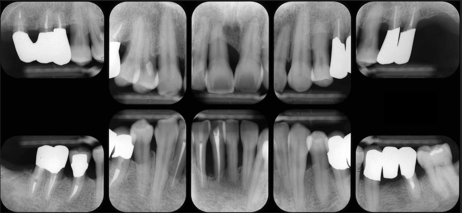 中等度歯周病 中等度歯周炎最終補綴物装着時レントゲン