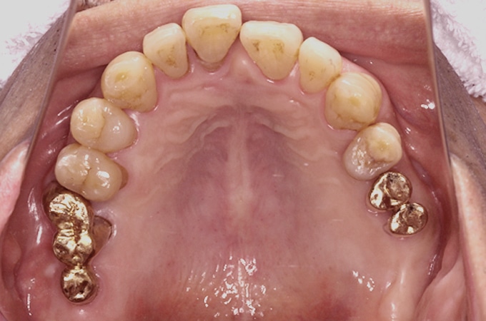 中等度歯周病 中等度歯周炎最終補綴物装着時