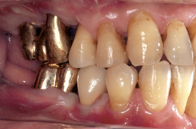 中等度歯周病 中等度歯周炎最終補綴物装着時