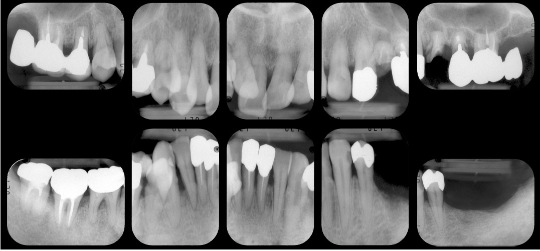 重度歯周病初診時レントゲン