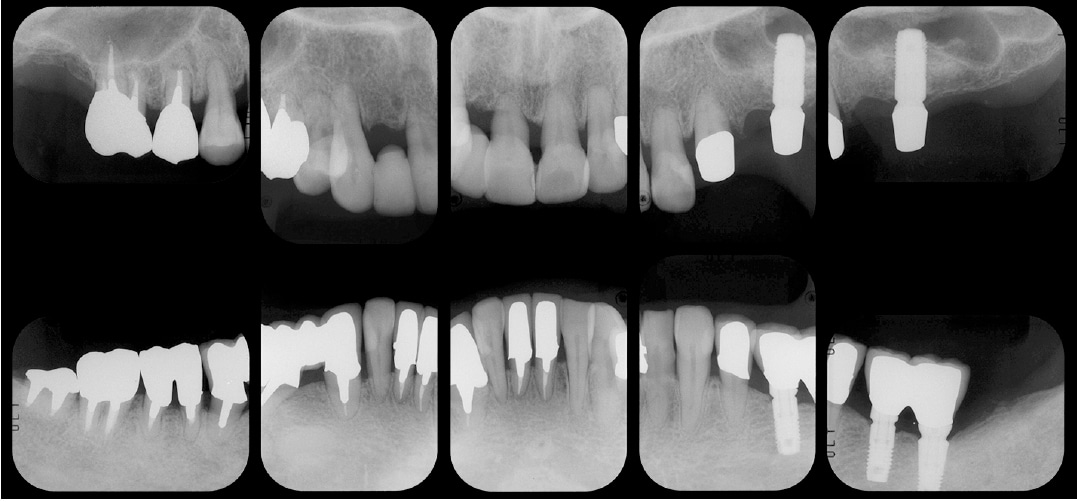 重度歯周病治療終了時のレントゲン