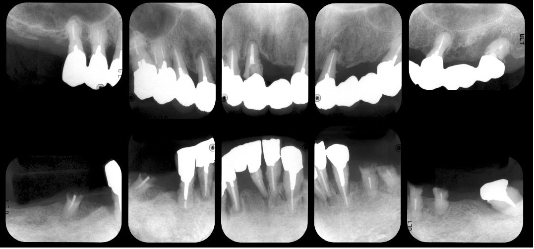 重度歯周病初診時レントゲン