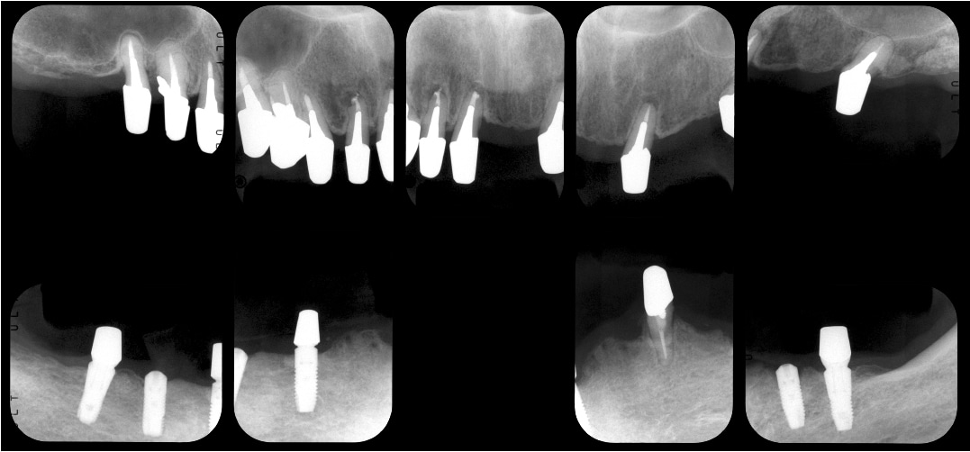 重度歯周病療終了時のレントゲン