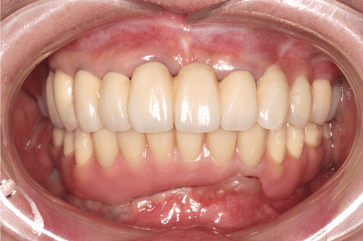 重度歯周病顎コーヌス・テレスコープ義歯