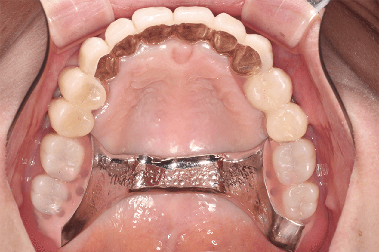 重度歯周病顎コーヌス・テレスコープ義歯