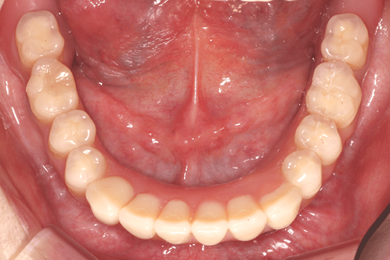 重度歯周病下顎　インプラント＆コーヌス・テレスコープ義歯