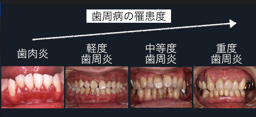 歯周病の進行段階